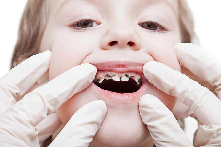 Tratamiento de caries - Odontopediatría Jaén